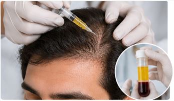 prp-for-hair-growth